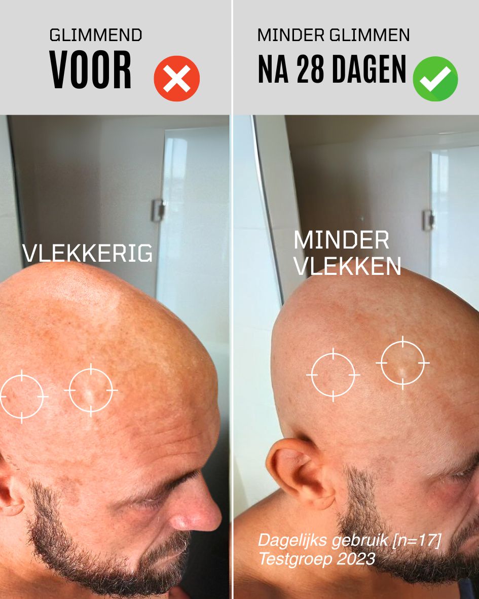 Anti-glim lotion voor de kale hoofdhuid met Uv-filter